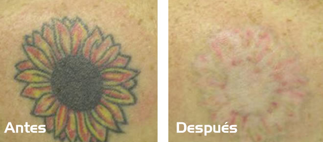Tatamientos eliminacion tatuajes - Tensado piel
