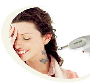 eliminacion tatuajes en Leon